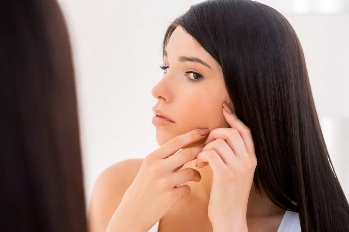 Acne Scar Removal