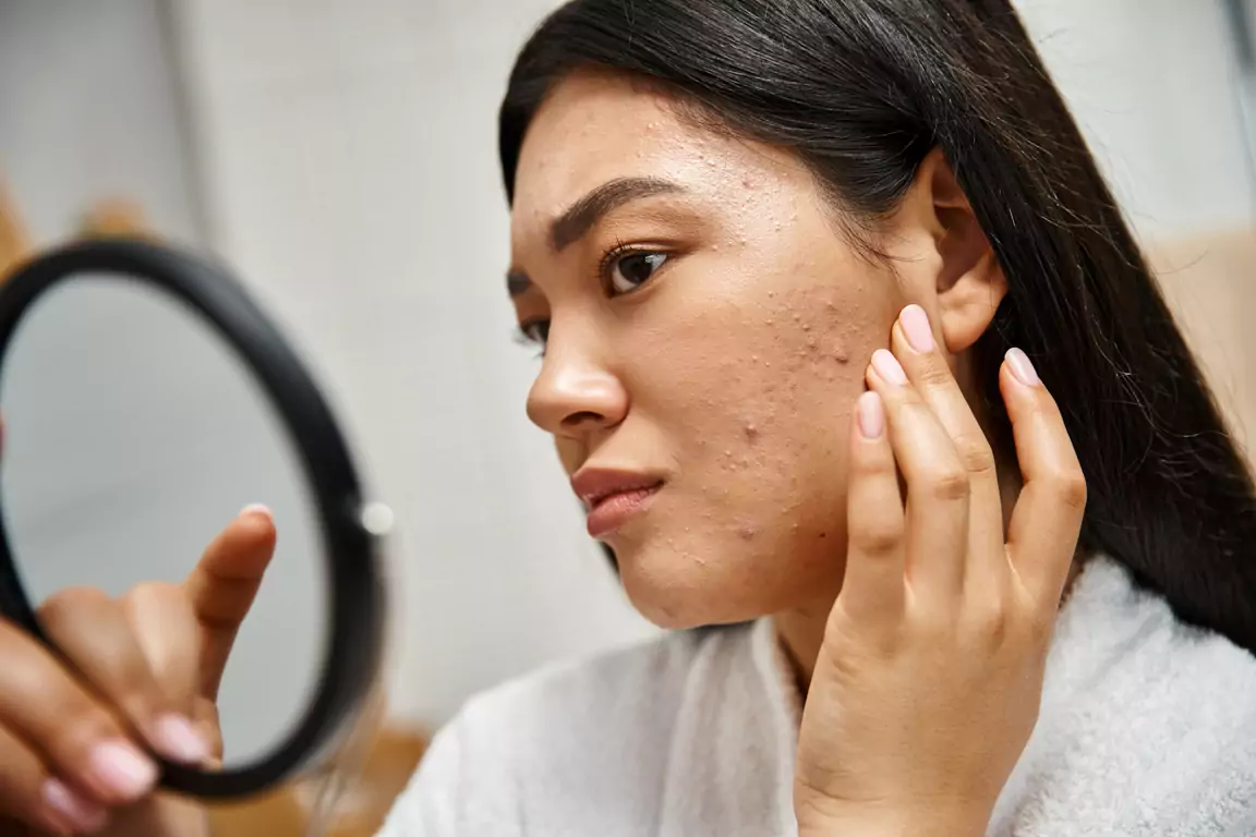 Acne Treatment Clinic