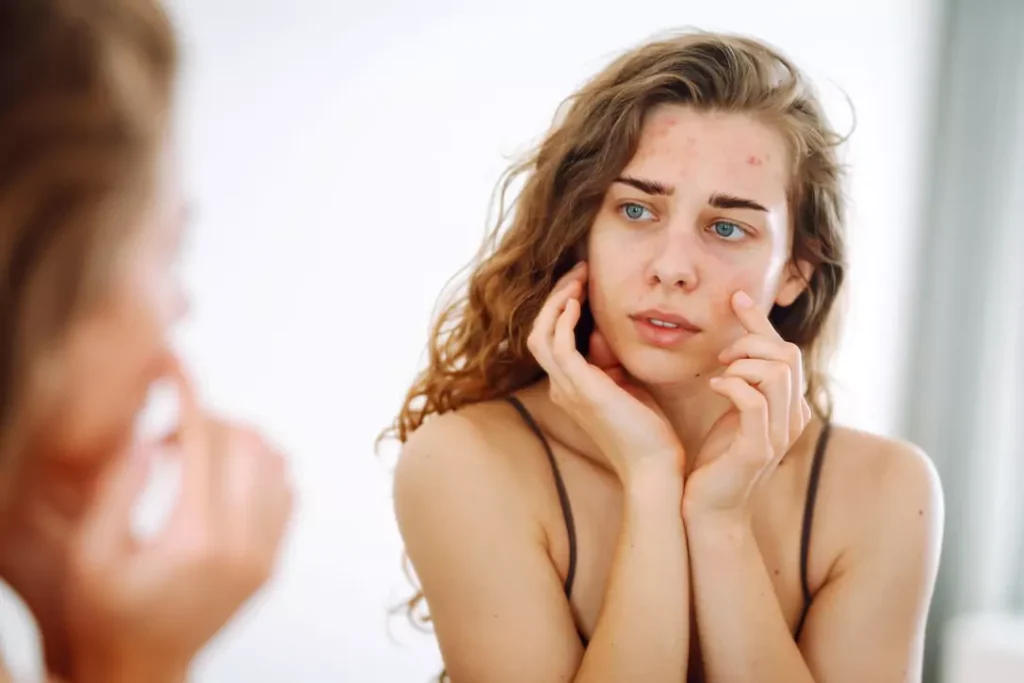 Acne Treatment Toronto