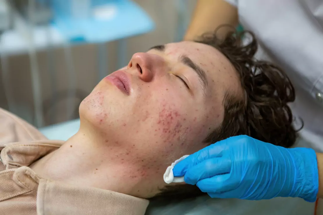 Face Acne Treatment