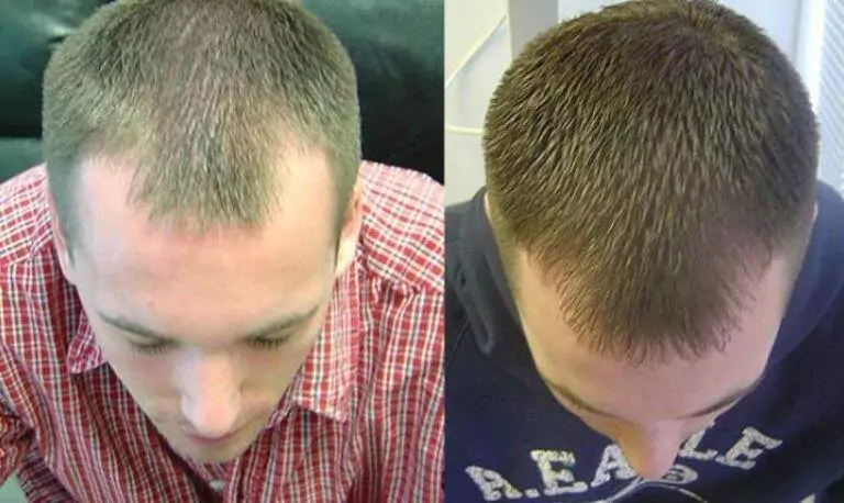Hair Laser Toronto