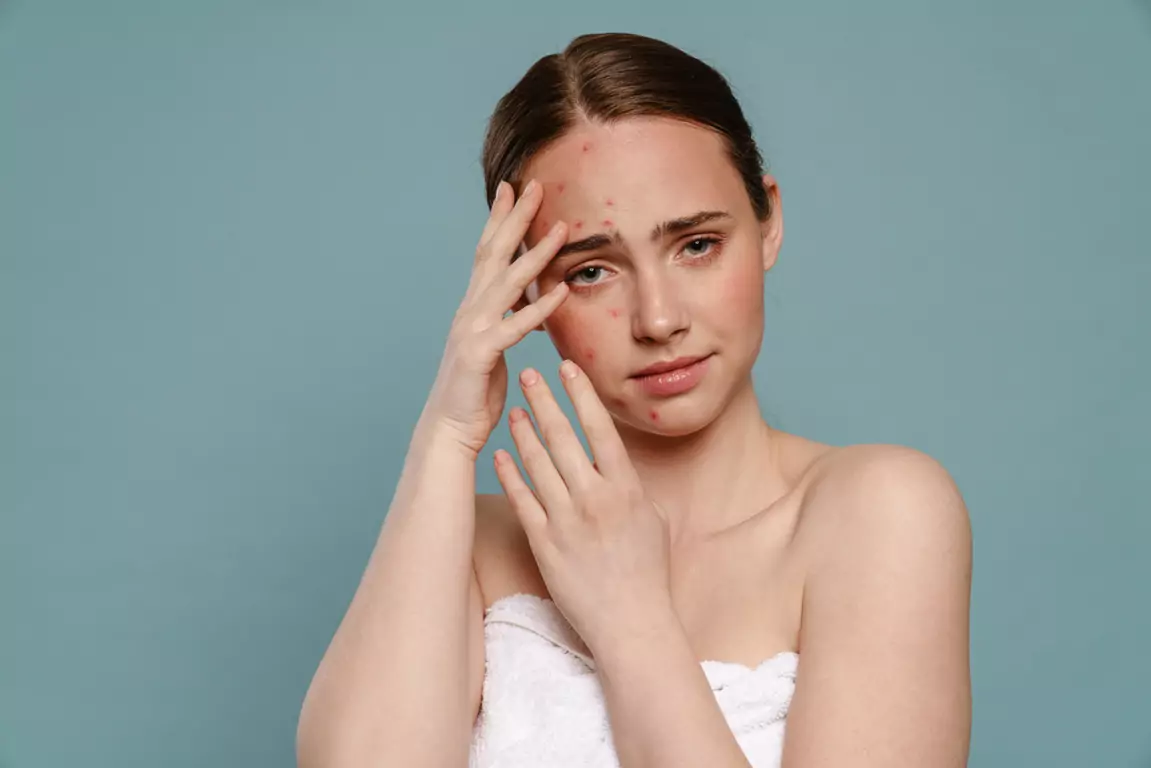 Laser Treatment For Pimples