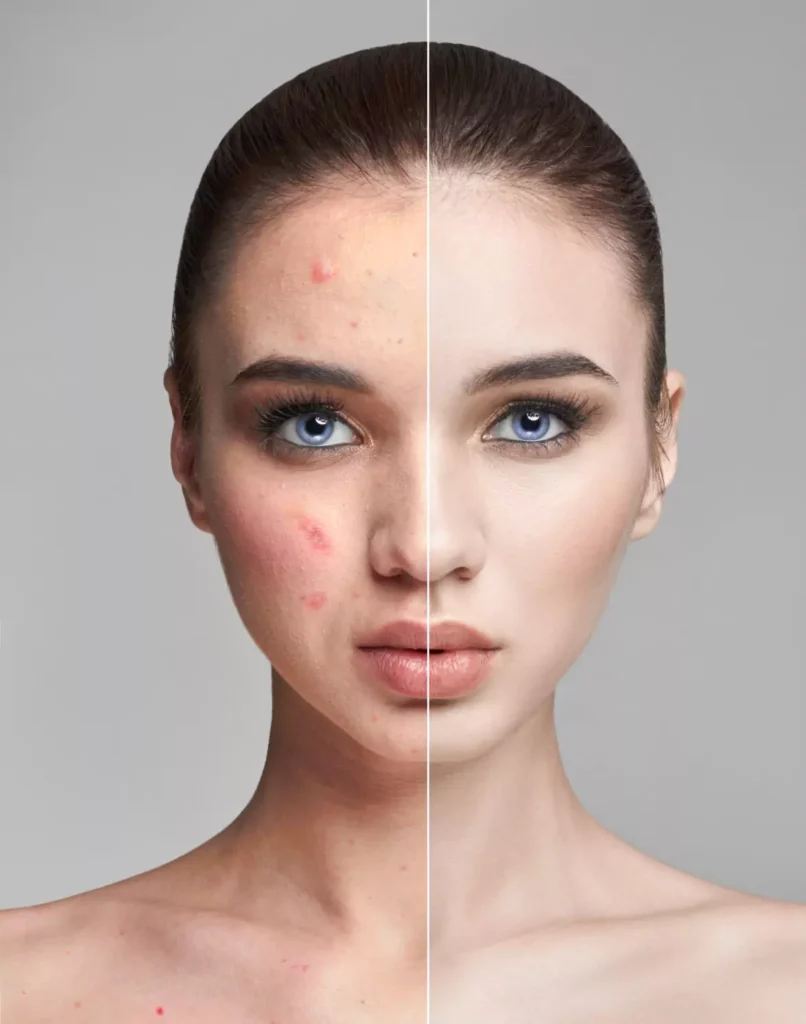 Laser Treatment For Pimples