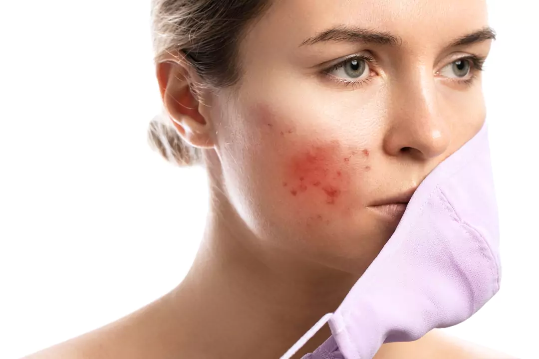 Best Rosacea Treatment