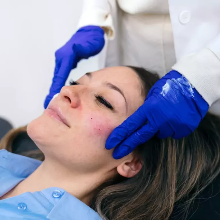 Rosacea Treatment Toronto