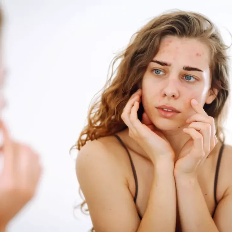 Acne Treatment Toronto